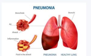 लहान मुलांमधील न्यूमोनिया
