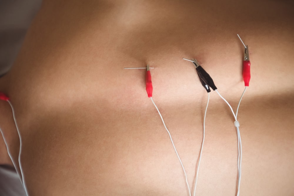 What is Acupuncture
