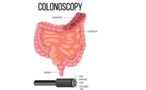 कोलनॉस्कोपी म्हणजे काय - Colonoscopy meaning in Marathi