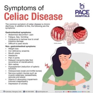 सिलिएक डीसिज –Celiac Disease information in Marathi