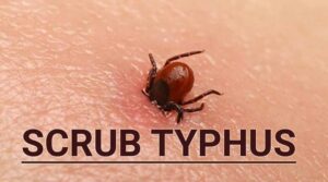 Scrub typhus in Marathi –